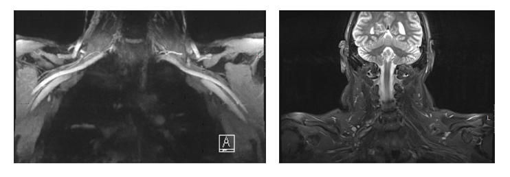 MRI להדמיית עצבים פריפריים