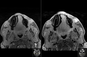 MRI לחומרי מילוי בפנים