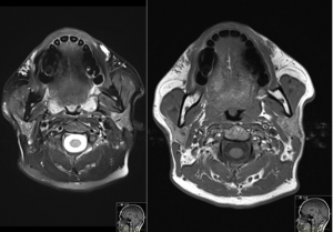 הדמייה של בדיקת MRI לחומרי מילוי בפנים