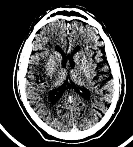 בדיקת ct מוח