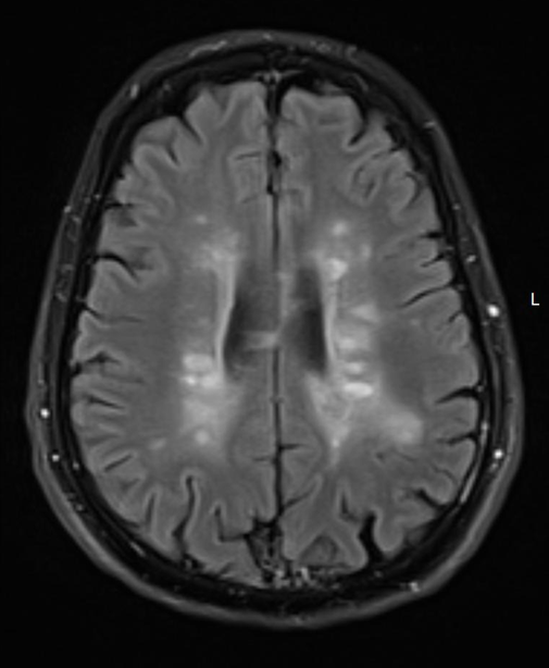 MRI מוח מחלת טרשת נפוצה