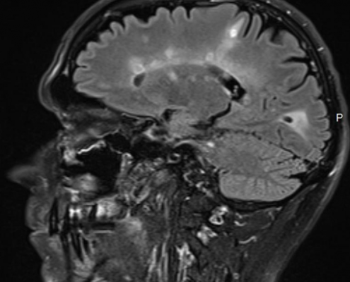 הדמיית MRI במחלת טרשת נפוצה