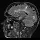 הדמיית MRI במחלת טרשת נפוצה