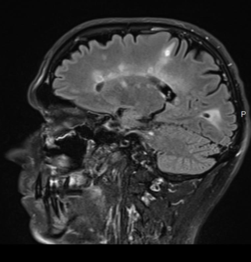 הדמיית MRI במחלת טרשת נפוצה