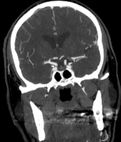 בדיקת CT אנגיוגרפיה