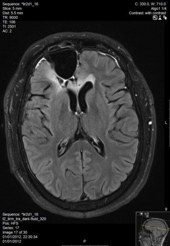 MRI ראש