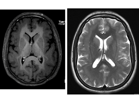 תוצאות בדיקת MRI לילדים