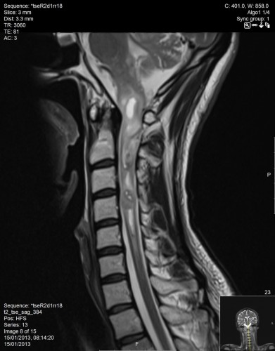 בדיקת MRI עמוד שדרה צווארי