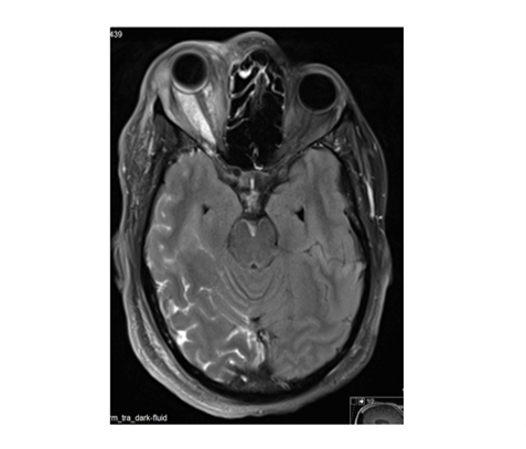 בדיקת MRI בילד עם אפילפסיה ומחלת טוברוס סקלרוזיס