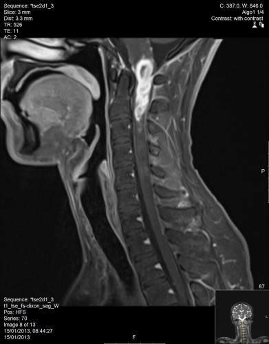 MRI עמוד שדרה