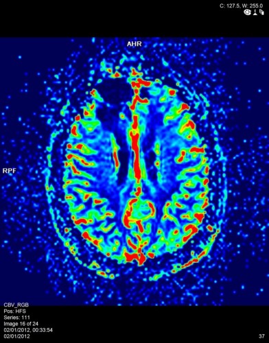 MRI מוח