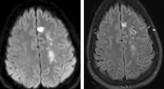 עקב ממצא זה בוצע MRI באופן מיידי על מנת להעריך את מידת הנזק המוחי. בMRI ניתן לראות נזק מוחי קטן ברקמת המוח
