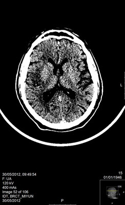 CT מוח ללא הזרקת חומר ניגודי