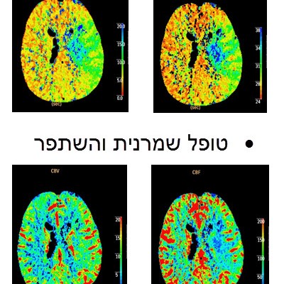 CT פרפוזיה