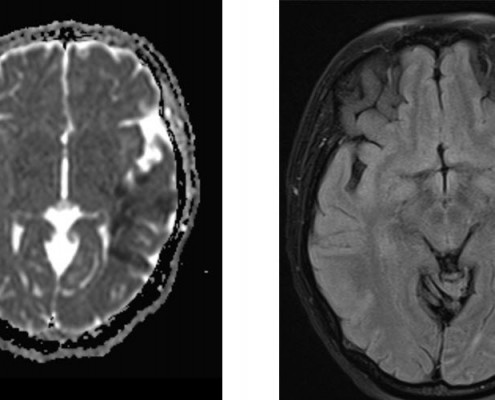 mri באוטם חד