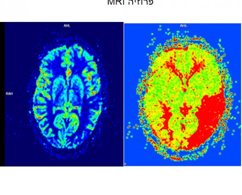 mri פרפוזיה