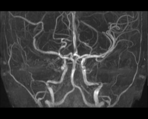 MRI אנגיוגרפיה