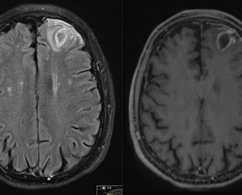 בדיקת mri פרטי לגבר בן 68 עם שאלה של אבסס מוחי