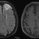 בדיקת mri פרטי לגבר בן 68 עם שאלה של אבסס מוחי