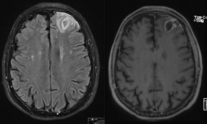 בדיקת mri פרטי לגבר בן 68 עם שאלה של אבסס מוחי