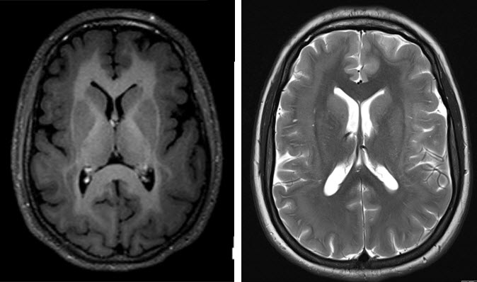 mri מוח של בחורה בת 20 לטיפול בפרכוסים