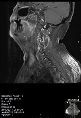 בדיקת MRI של עמוד שדרה צווארי