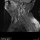 בדיקת MRI של עמוד שדרה צווארי