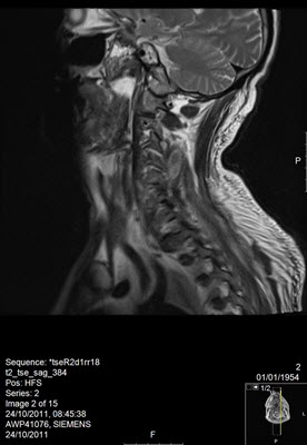 mri cervical spine