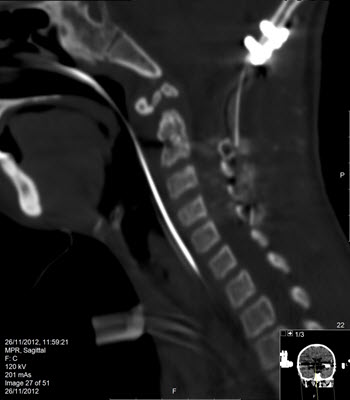 mri לילדים בדיקה לאחר נפילה