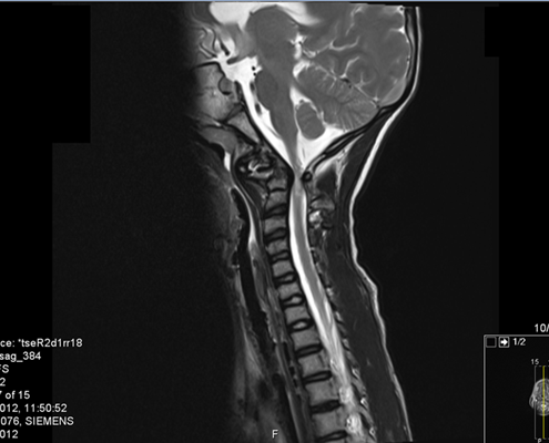 mri לילדה לאחר נפילה