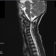 mri לילדה לאחר נפילה