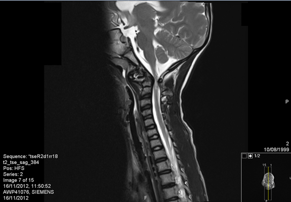 mri לילדה לאחר נפילה