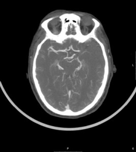 בדיקת ct מוח של גבר בן 60
