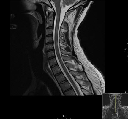 mri עמוד שדרה צווארי של בחורה בת 38