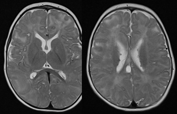 An example of a child with epilepsy in light of congenital disease affecting the brain.