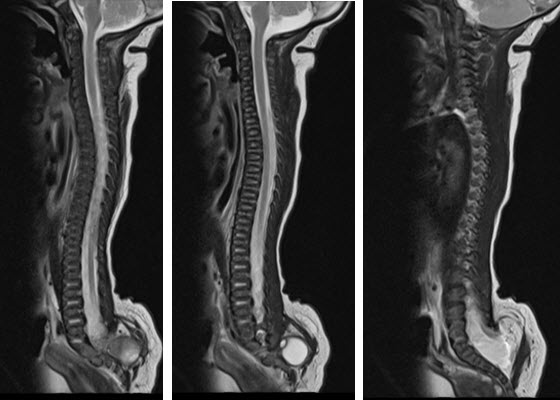 בדיקת MRI עמוד שדרה לילדים