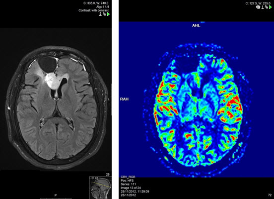 חזרת גידול במיטת הניתוח ב MRI מוח כולל פרפוזיה מוחית.