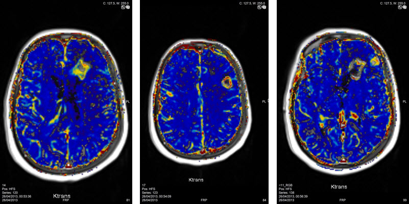 בדיקת MRI מוח כולל פרפוזיה מוחית להדגמת גידולי מוח