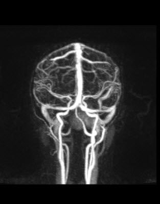 MRA demonstrating the blood vessels inside