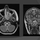 mri head of the 15-year-old boy