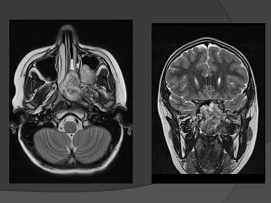 mri head of the 15-year-old boy