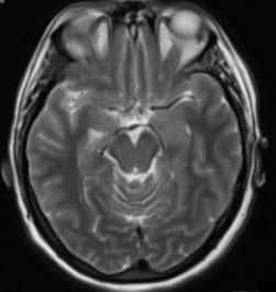 MRI לאישה בת 54