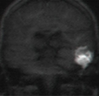 בדיקת MRI עם דיפוזיה