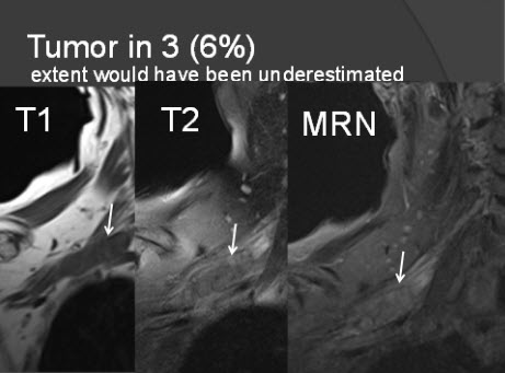 בדיקת MRI נוירוגרפיה