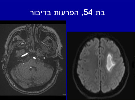 בדיקת MRI המדגימה אוטם מוחי חד