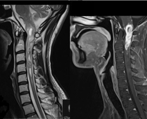 בדיקת MRI המדגימה תהליך בחוט הצווארי של נער בן 20