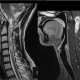 בדיקת MRI המדגימה תהליך בחוט הצווארי של נער בן 20