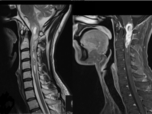 בדיקת MRI המדגימה תהליך בחוט הצווארי של נער בן 20