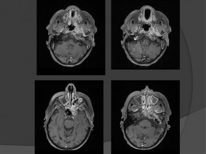 MRI מוח
