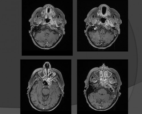 MRI מוח